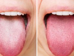 Warna Lidah Sebagai Cermin Kesehatan Tubuh dan Cara Mengenalinya