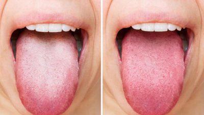 Warna Lidah Sebagai Cermin Kesehatan Tubuh dan Cara Mengenalinya