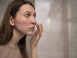 Rosacea Menyebabkan Wajah Merah, Kenali Gejala dan Cara Mengatasinya