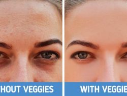 4 Jenis Lingkaran Hitam di Bawah Mata dan Cara Mengatasinya dengan Tepat